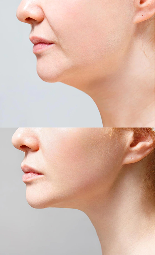 chin cheek contouring