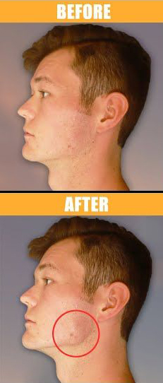 jawline defining treatment