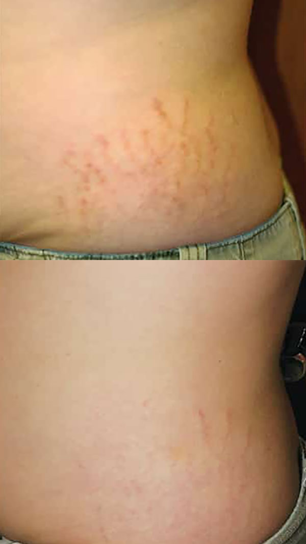 stretch mark reduction